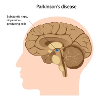 PARKİNSON HASTALIĞI İLE  APANDİS ARASINDA İLİŞKİ BULUNDU.