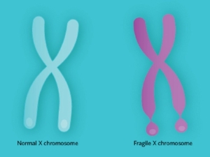 Fragile X İlişkili Primer Over Yetmezliği (FXPOI) Ge...